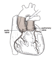 Double Valve Replacement India, Heart Valve Replacement